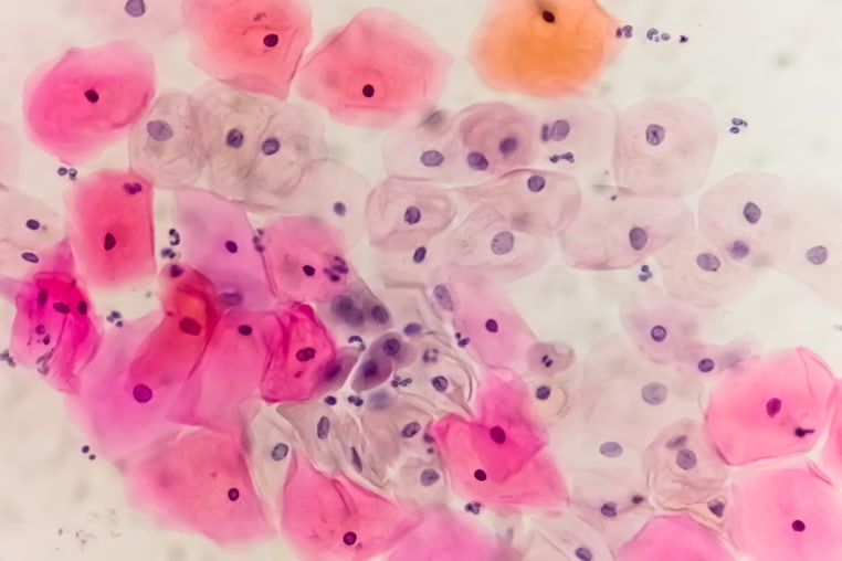 Paps smear under microscopy showing inflammatory smear with hpv related changes. Cervical cancer. SCC