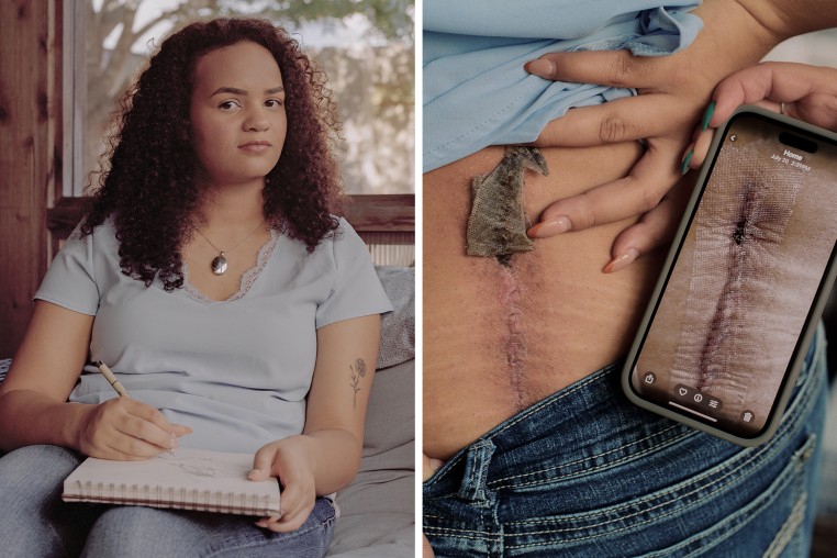 A split composite image of Nala White seated on a couch, left, and her lifting up her shirt to reveal scars on her back next to a phone showing a photo of said scar