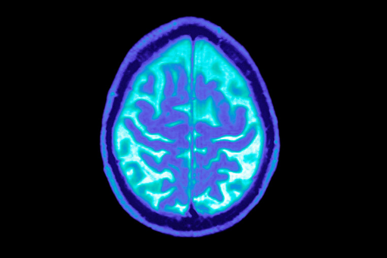 Alzheimer Disease, Mri brain scan